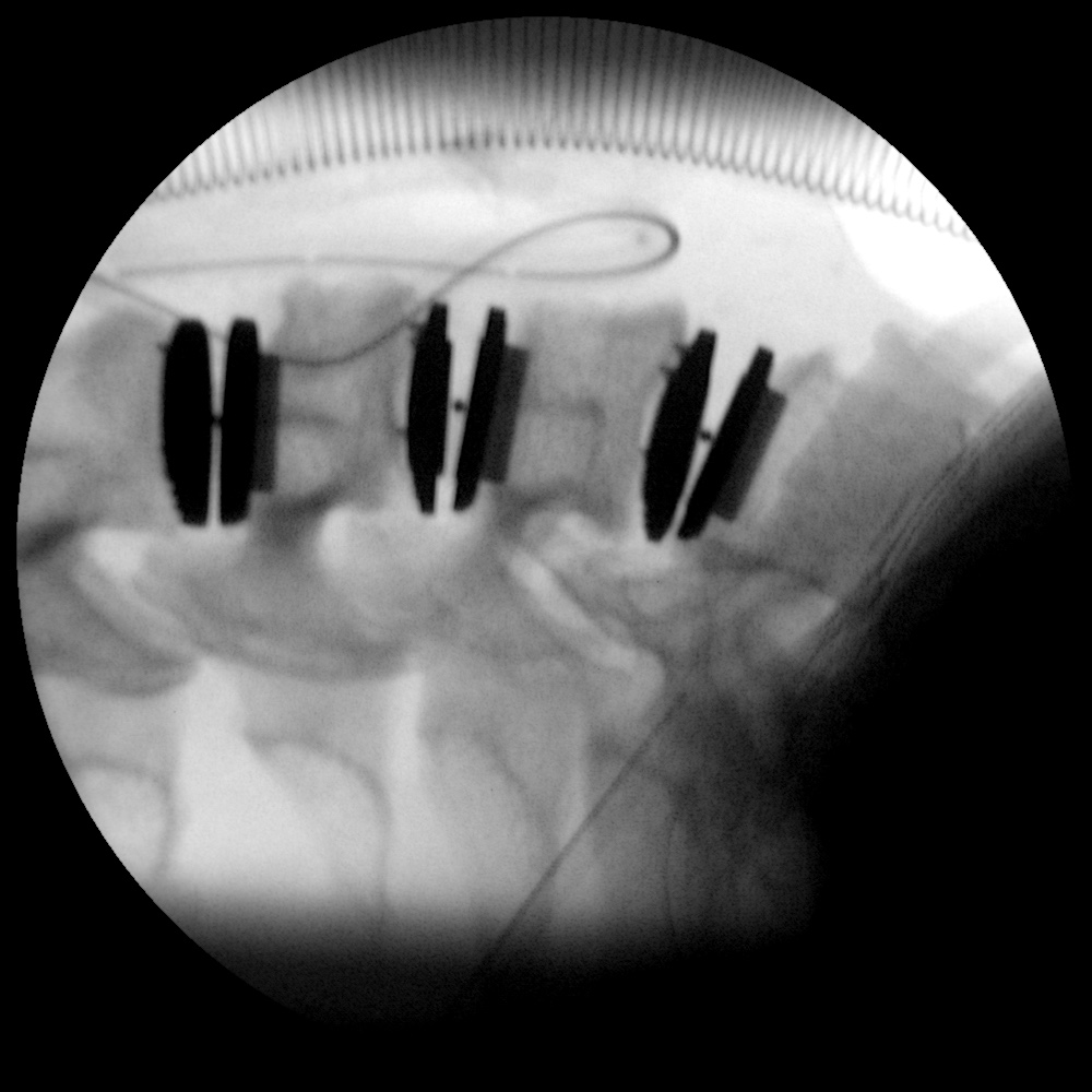 Cab_ retirada artrodesis cervical con implantesw moviles