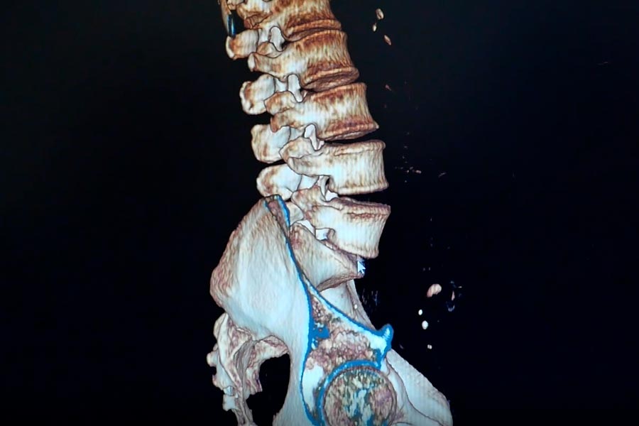 Caso clínico de hernia discal L5S1