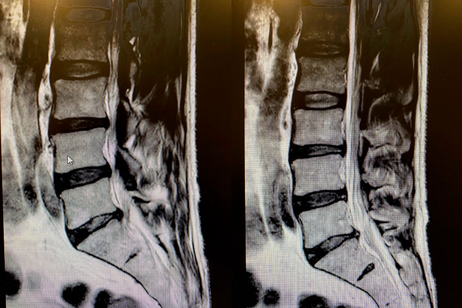 Caso Clínico endoscopia para extirpar hernia discal L5S1