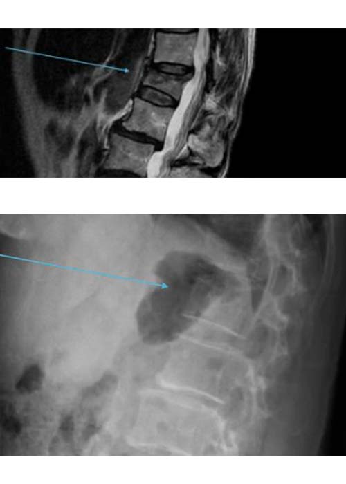 cifoplastia-en-madrid