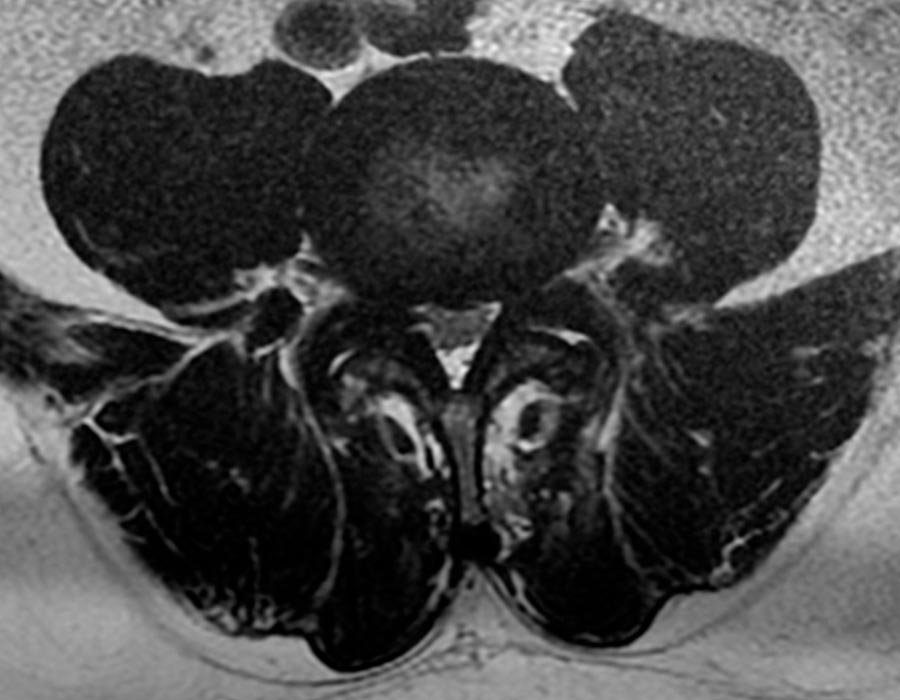 Cirugia endoscopia de columna