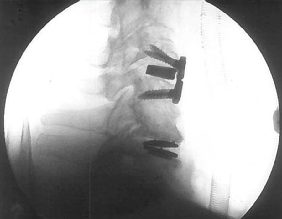 cirugia avanzada de columna cervical