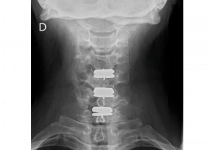 cirugia-de-columna-mínimamente-invasiva-en-madrid