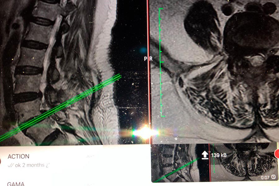 cirugia-discal-mínimamente-invasiva
