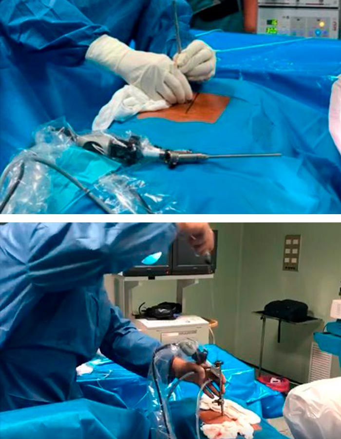 Cirugia endoscopia de columna
