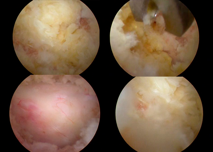cirugia-estenosis-de-canal-instituto-CAC