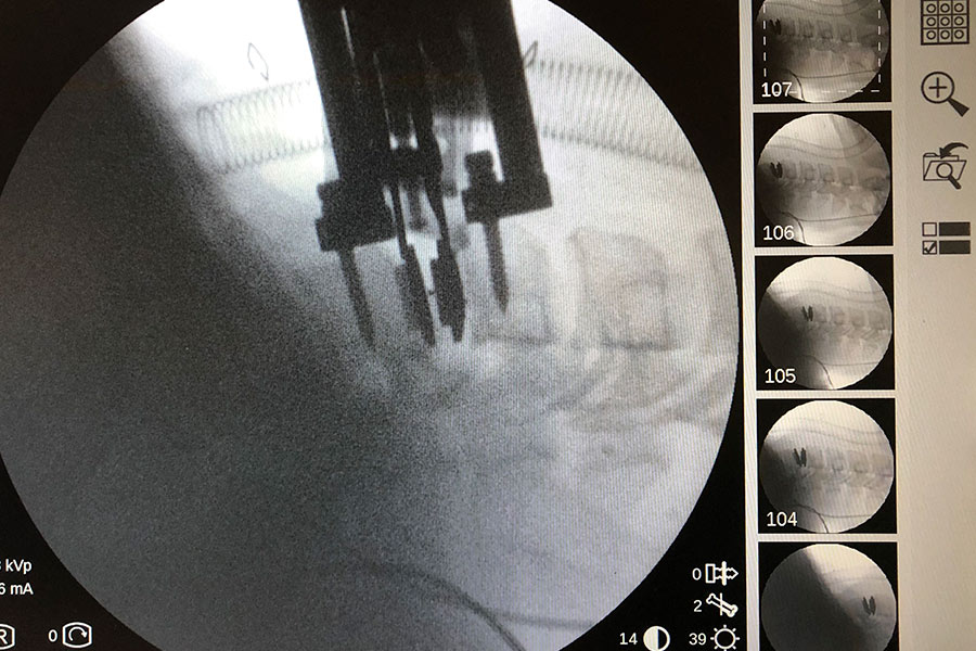 cirugia-protesis-cervical-compleja