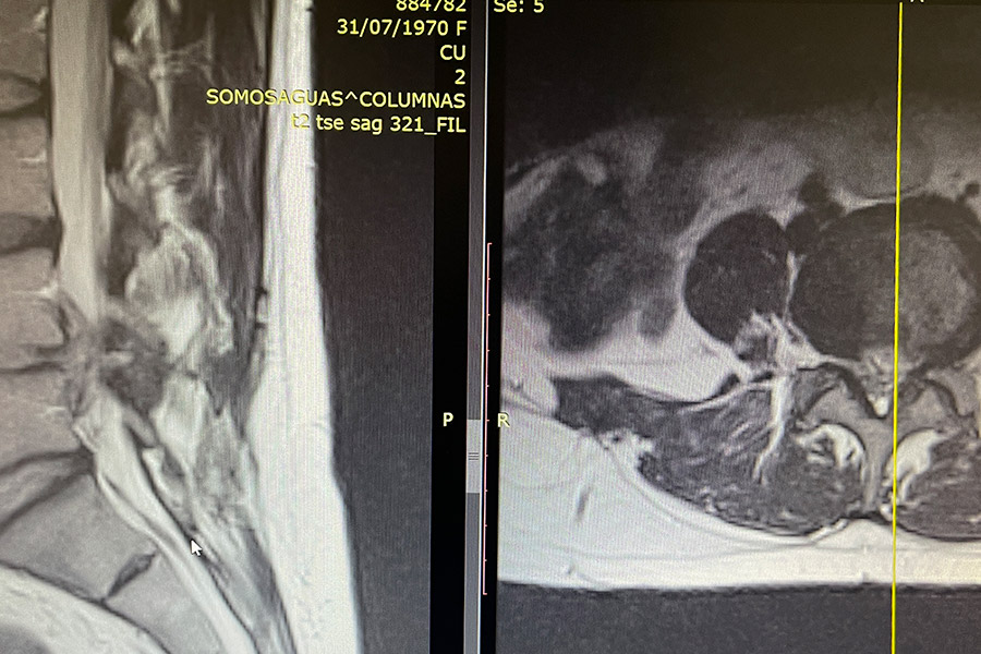 caso clinico recidiva l4l5