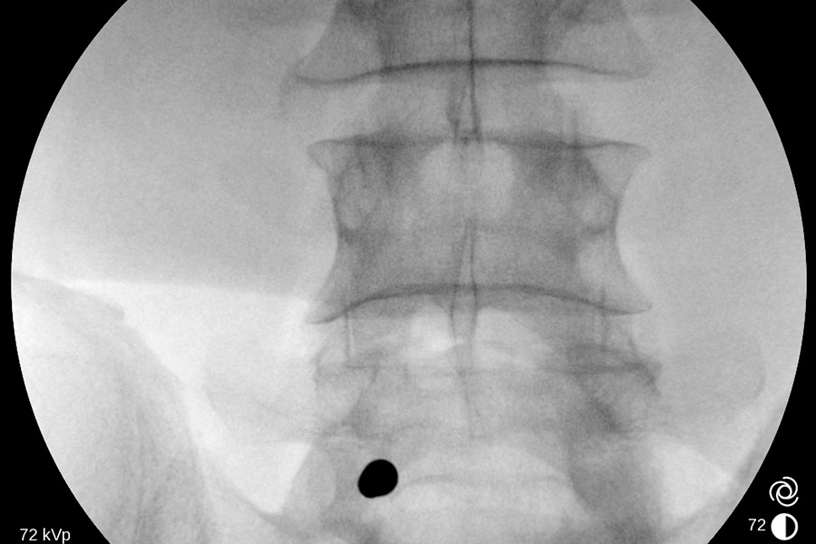 caso clinico hernias discales L4L5 transforaminal y L5S1 interlaminar