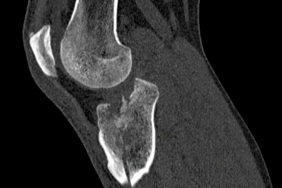 destacada-fractura-tibial