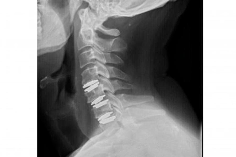 destacada-protesis-cervical-movil