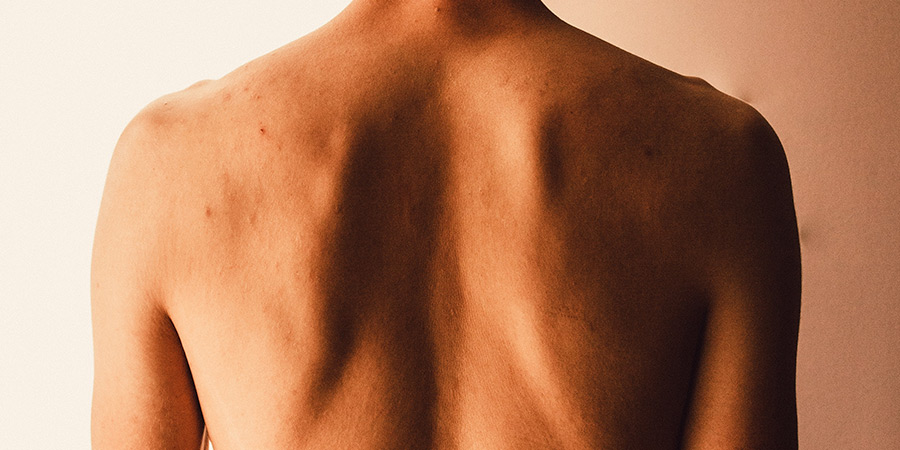 Diagnóstico-de-las- hernias-intervertebrales