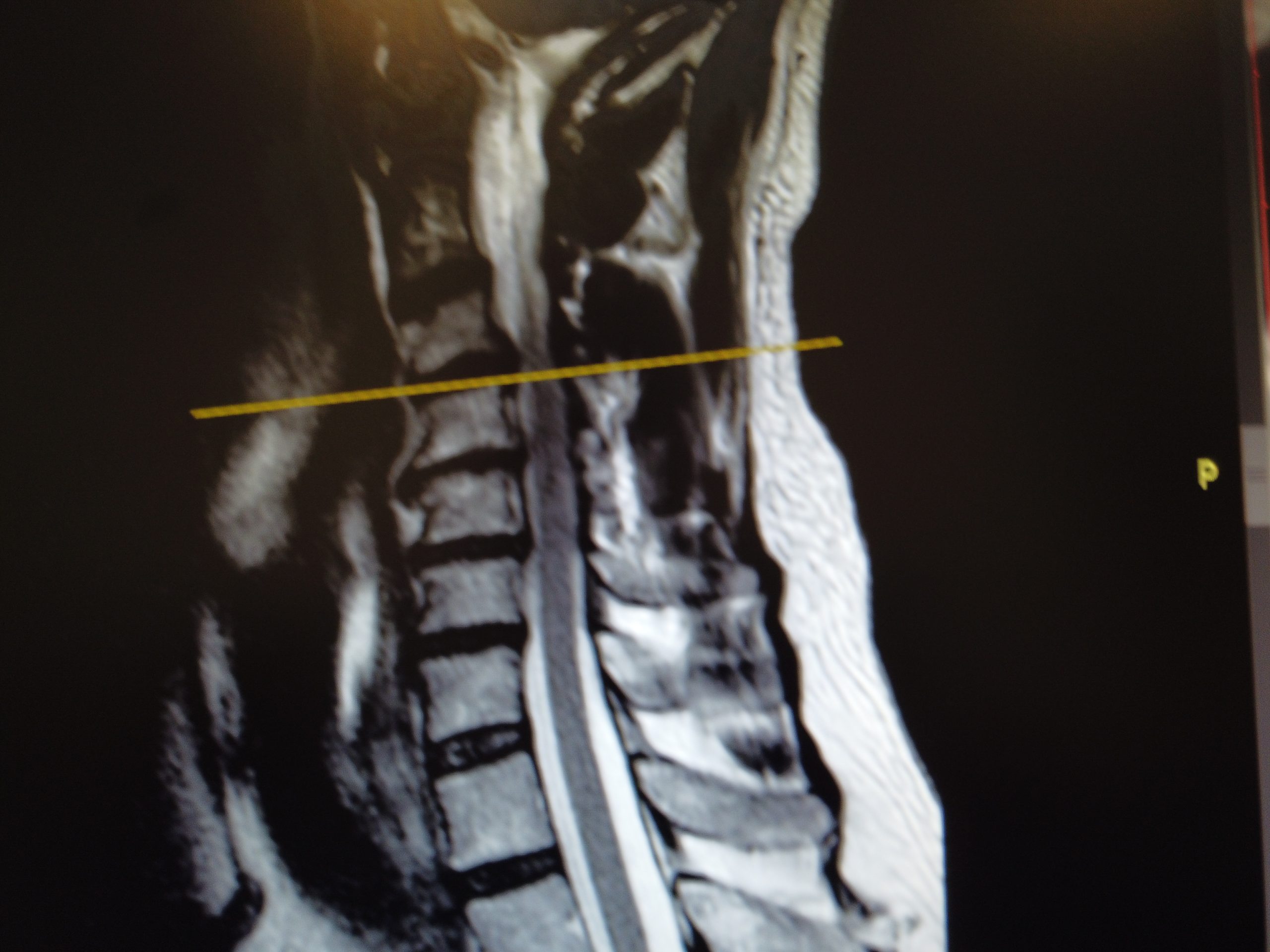 hernias discales cervicales miltiples