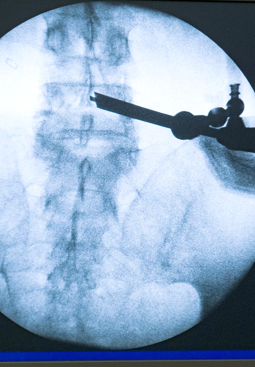 endoscopia avanzada de columna minimamente invasiva en madrid