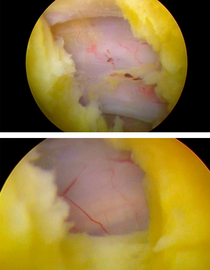 endoscopia columna vertebral paciente