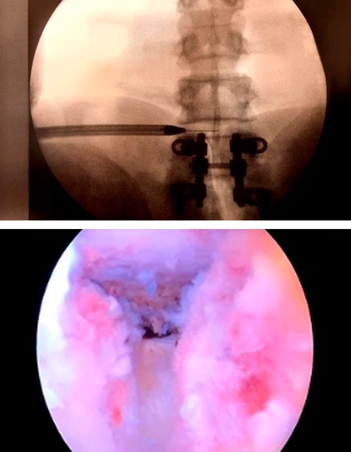 Endoscopia de columna para extraccion hernia discal