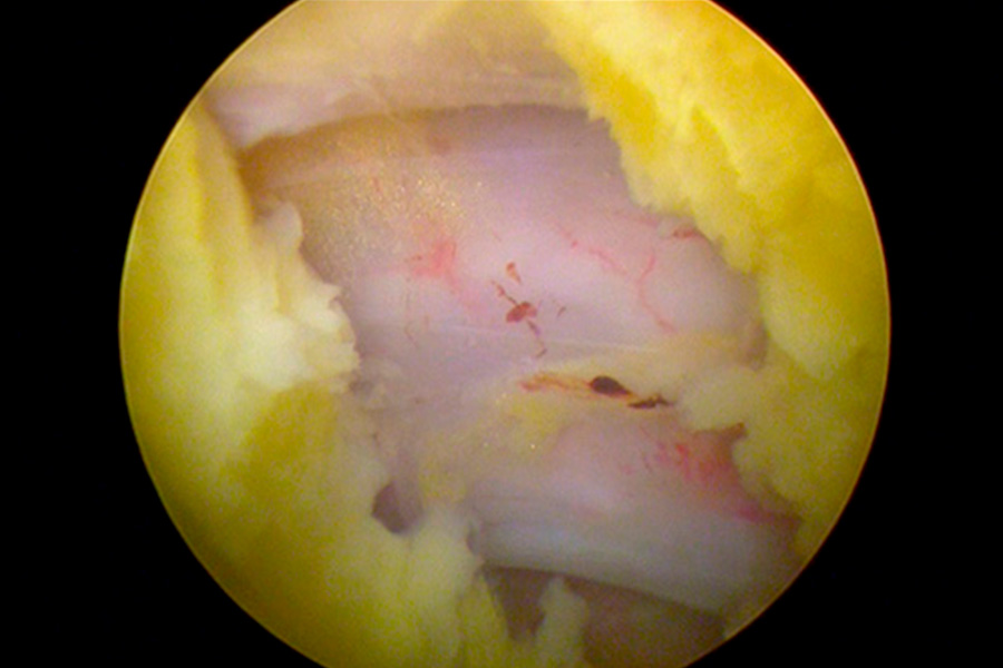 Endoscopia de columna