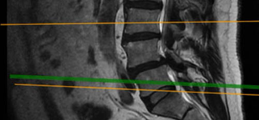 endoscopia-de-columna-vertebral-en-españa