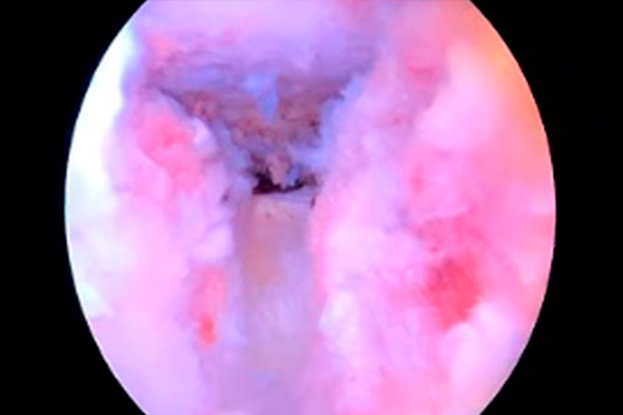 Endoscopia de vertebra