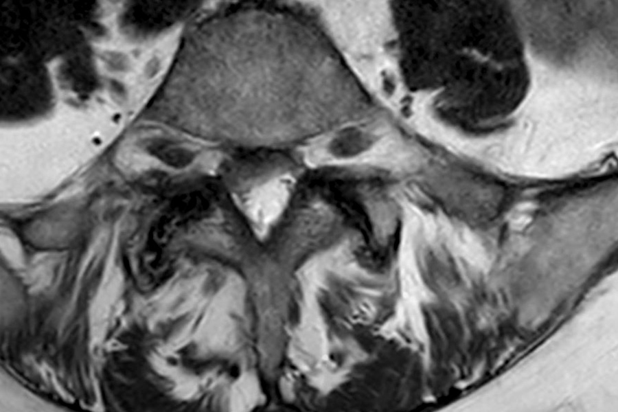 estenosis canal multinivel caso clinico_