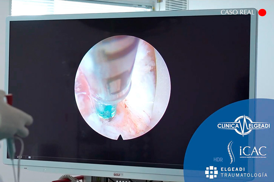 estenosis canal multinivel icac caso clinico