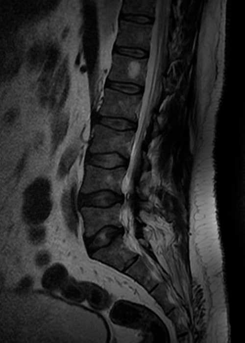 Estenosis de canal central