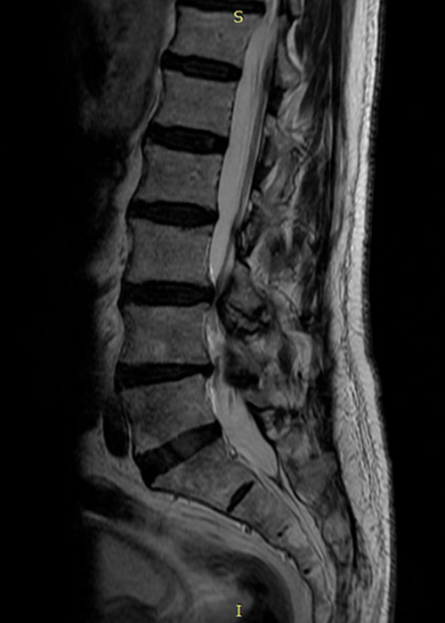 estenosis de canal radiografia