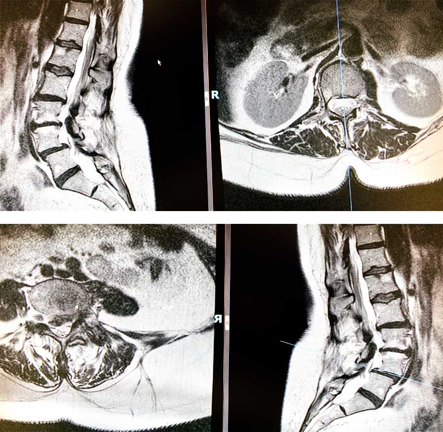 Estenosis de dos niveles radiografias