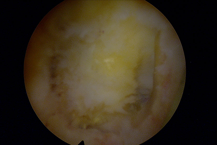Estenosis de dos niveles