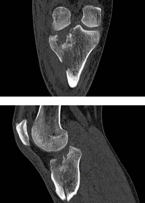 fractura-de-la-meseta-tibial