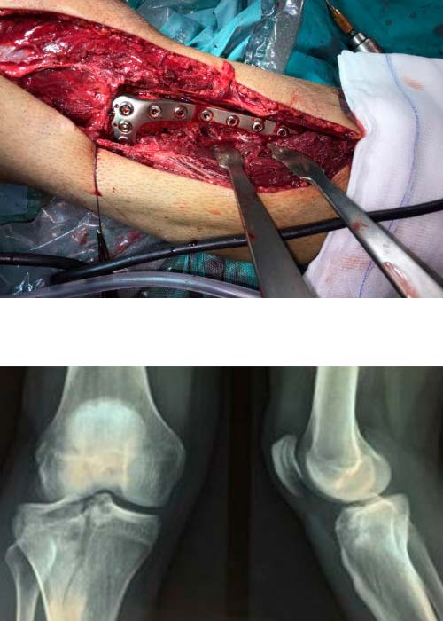 fractura-meseta-tibial-operatorio