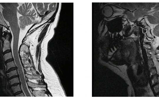hernia-discal-cervical-540x339
