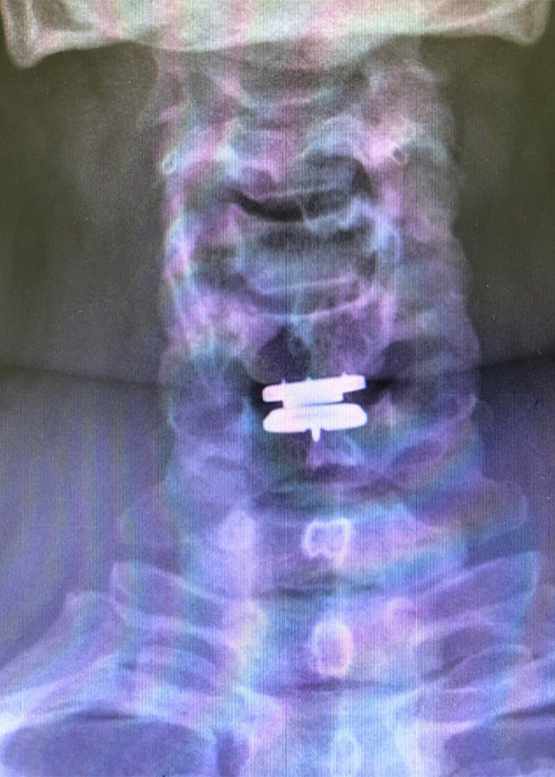 Hernia discal cuello