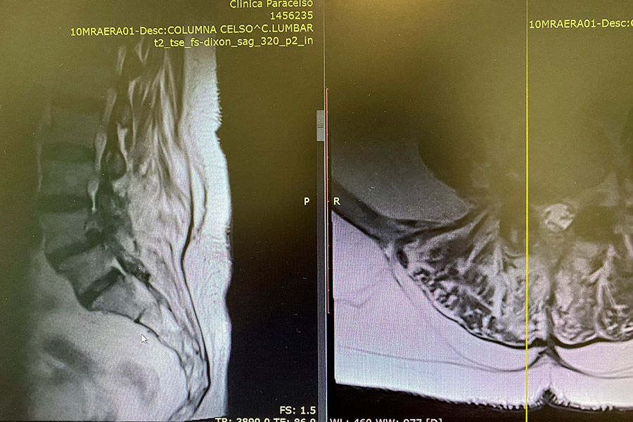 Hernia-discal-foramidal-josefa-carro-preop