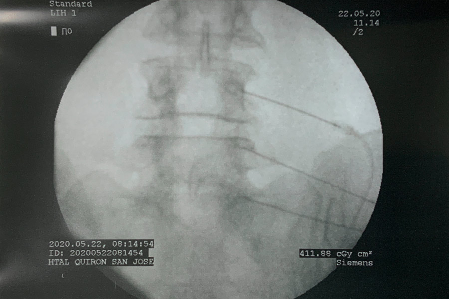 Hernia-discal-foramidal-josefa-carro