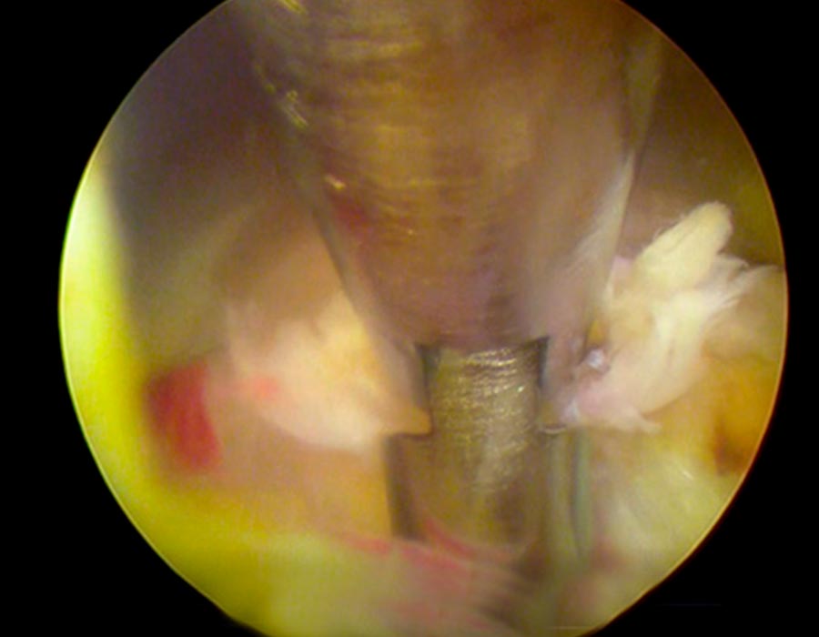 Hernia discal paciente joven