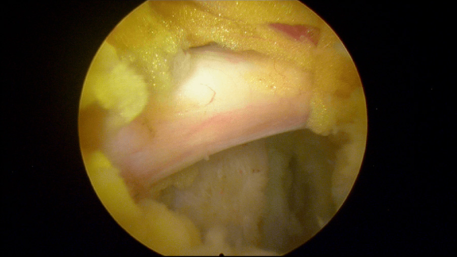 Hernia-discal-lateral-derecho