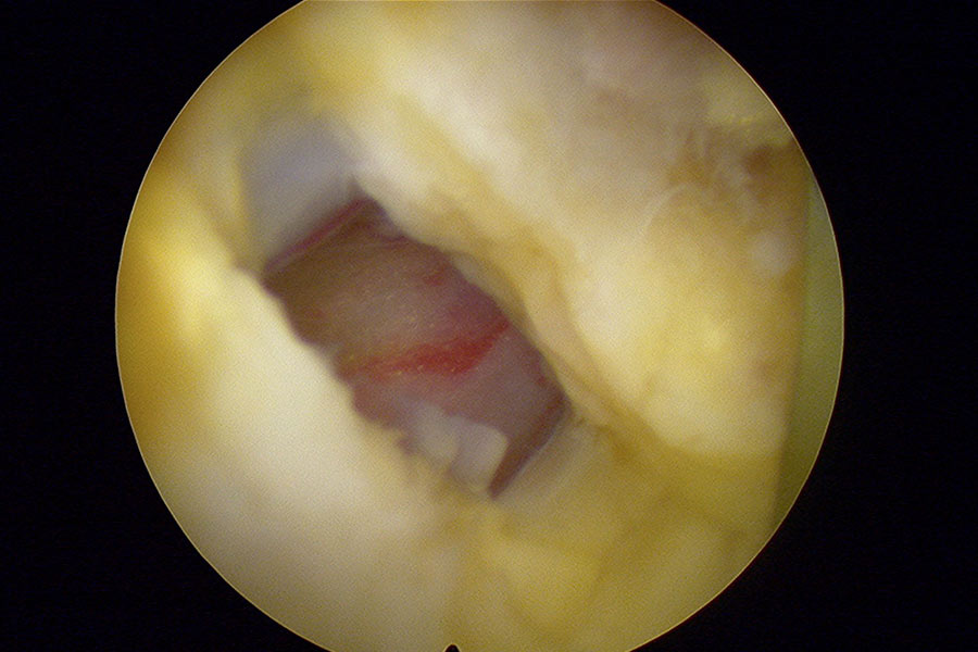 hernia-discal-lateralizada