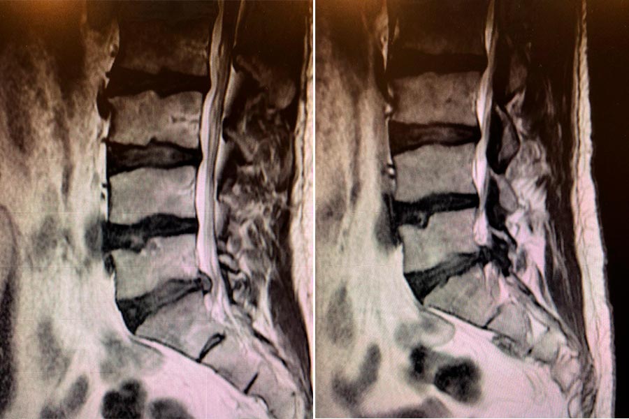 hernia-discal-lateralizada