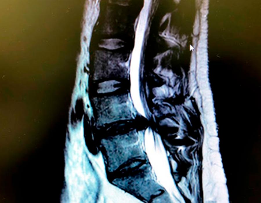 Hernia discal lumbar a extraer