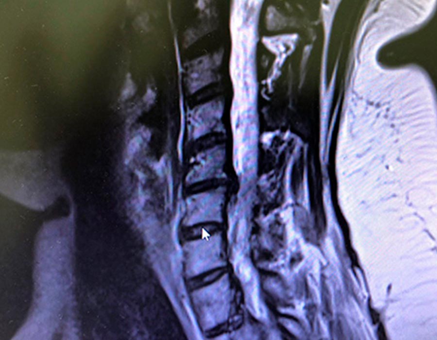 Cirugia hernia discal postoperatorio