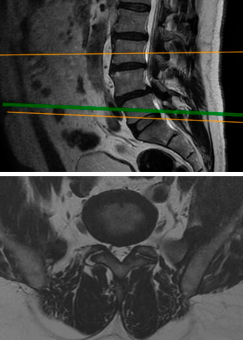 laminectomia-en-madrid-instituto-cac
