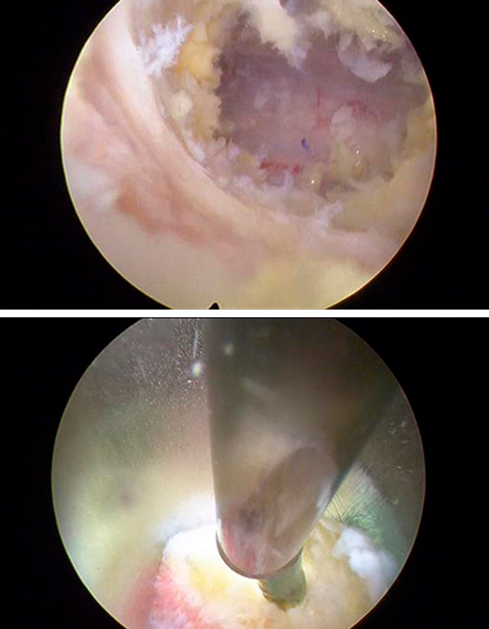 Liberacion de estenosis de canal