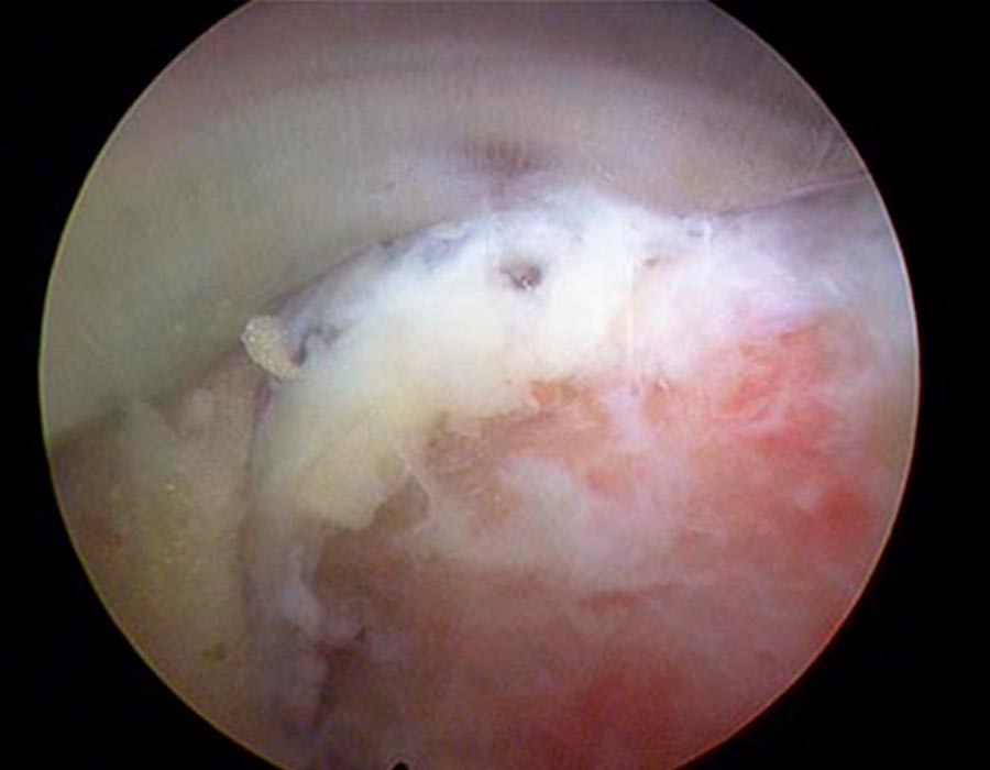 Liberacion de estenosis de canal