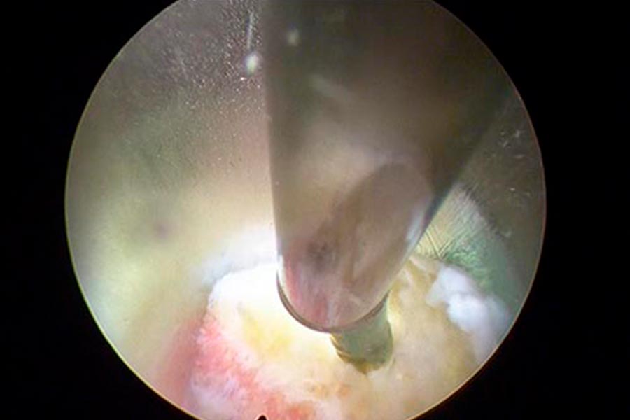 liberacion estenosis de canal