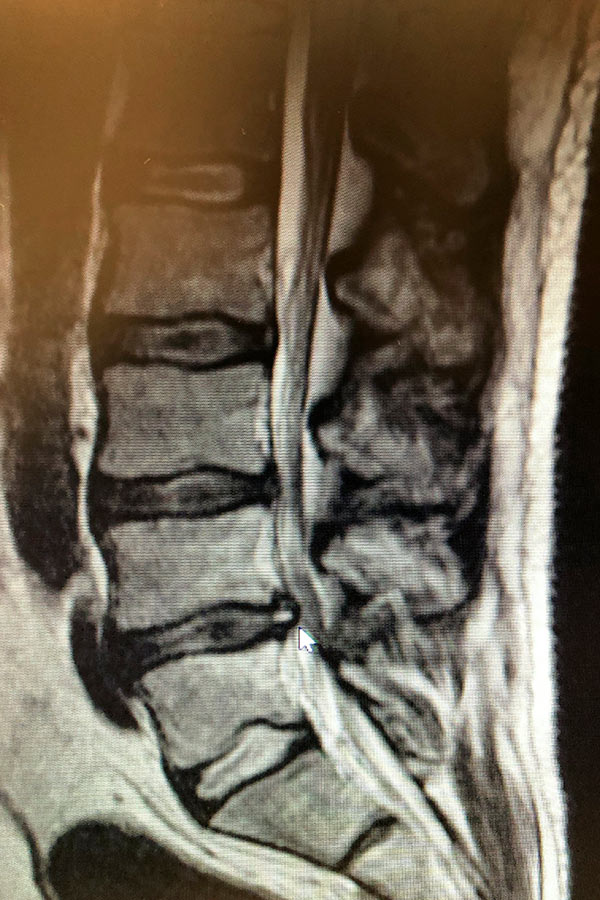 migracion-caudal-de-hernia-discal-lumbar
