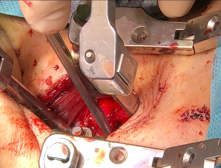 Operacion hernia cervical doble