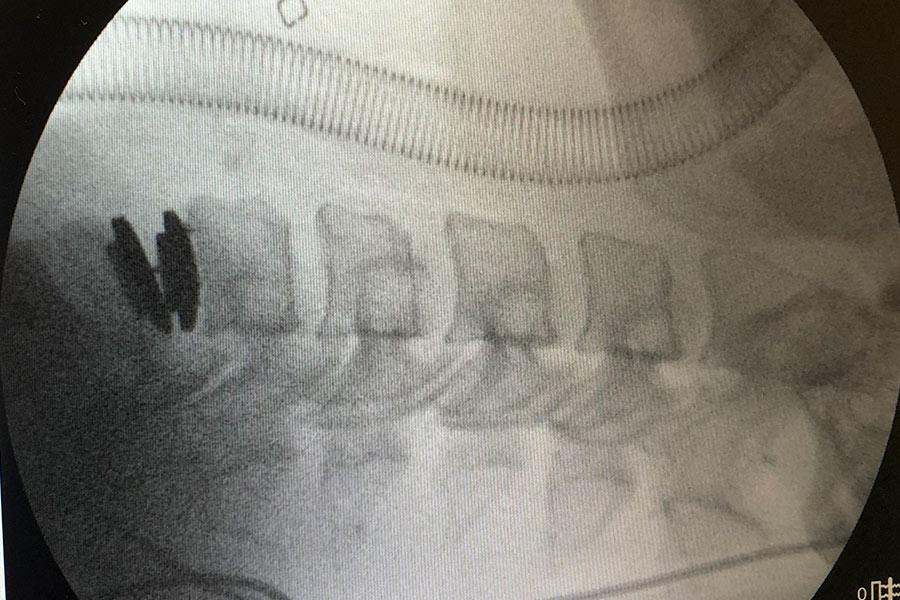 postcirugia-protesis-cervical-compleja