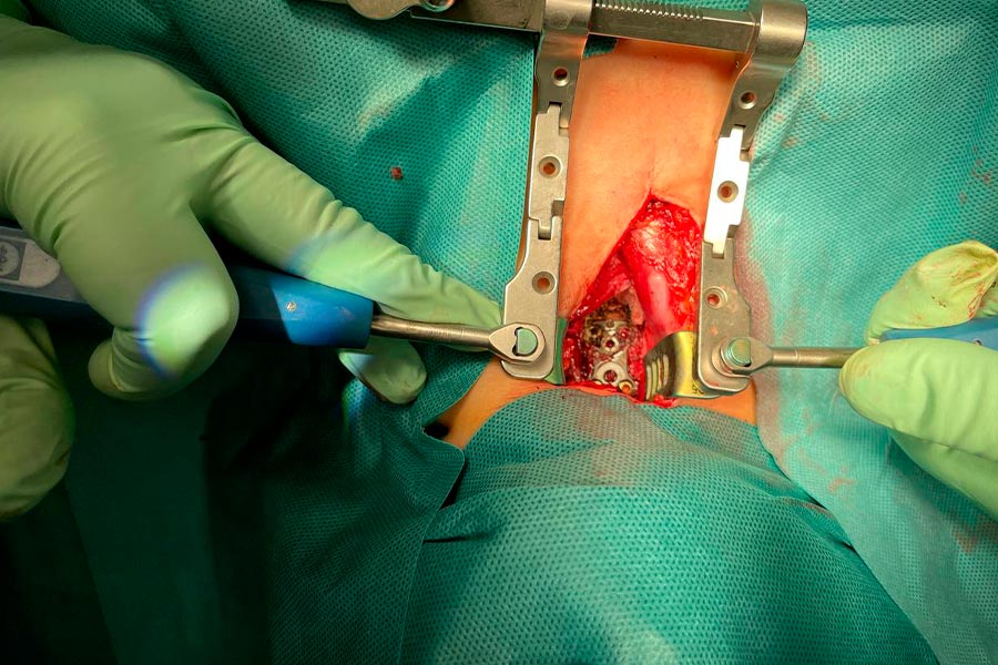 postoperatorio-artrodesis-cervical