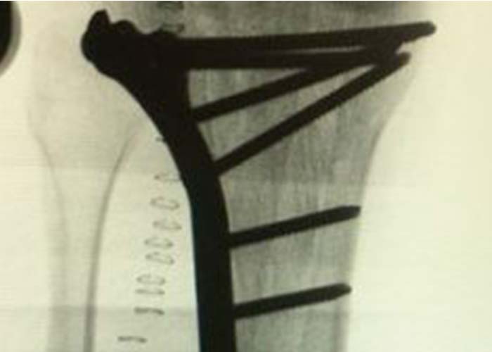 postoperatorio-fractura-meseta-tibial
